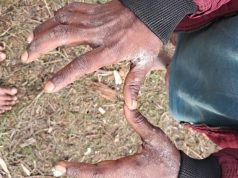 Gejala Gatal hingga Luka Bernanah Hajar Puluhan Anak – Anak dan Orang Tua, Warga Itlay Hisage Minta Pemeriksaan Medis Segera